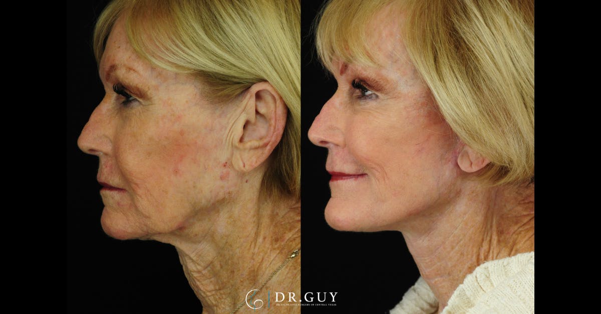 Mini Facelift Before & After Gallery - Patient 334067 - Image 4