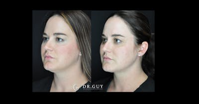 MyEllevate Before & After Gallery - Patient 156126 - Image 1