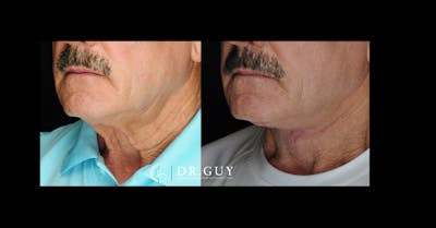 Neck Lift Before & After Gallery - Patient 338516 - Image 1