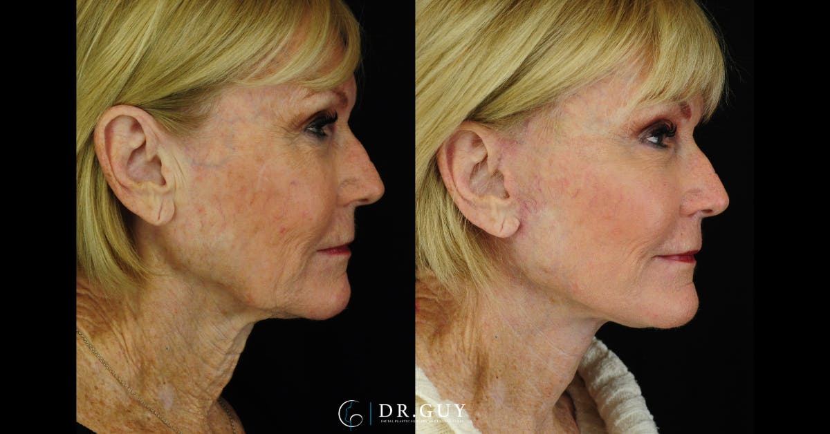 Mini Facelift Before & After Gallery - Patient 334067 - Image 5