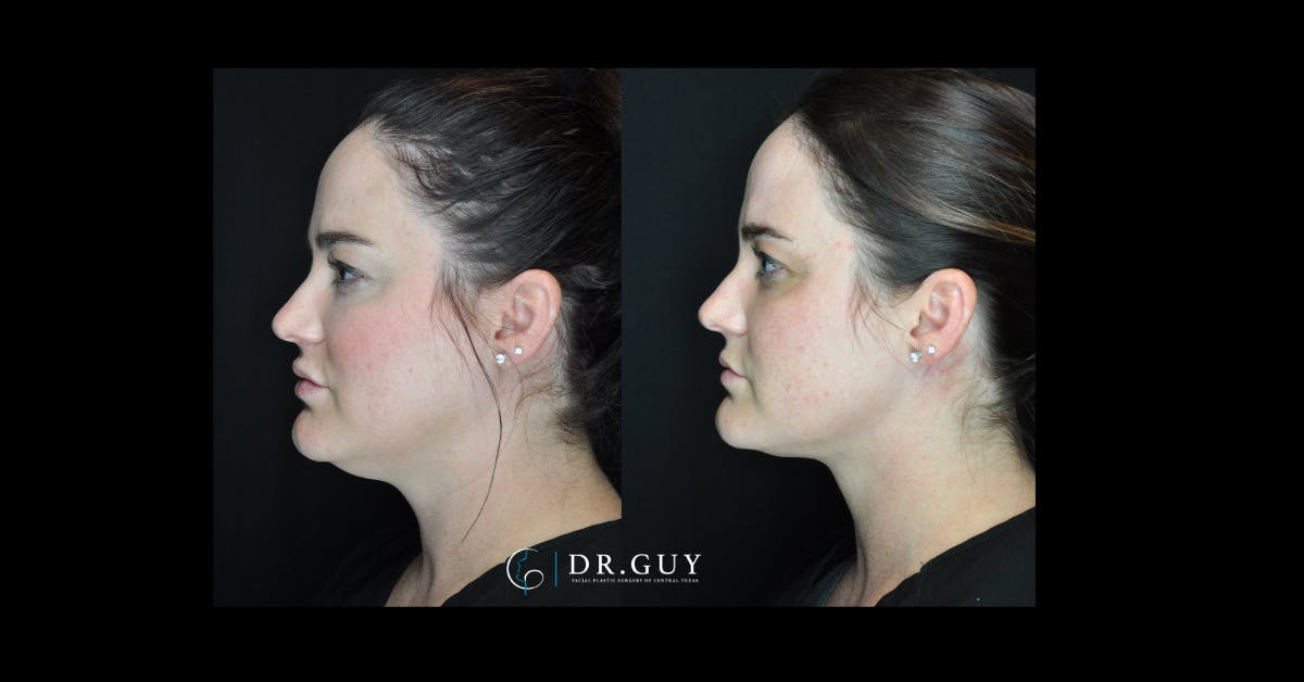 MyEllevate Before & After Gallery - Patient 156126 - Image 2