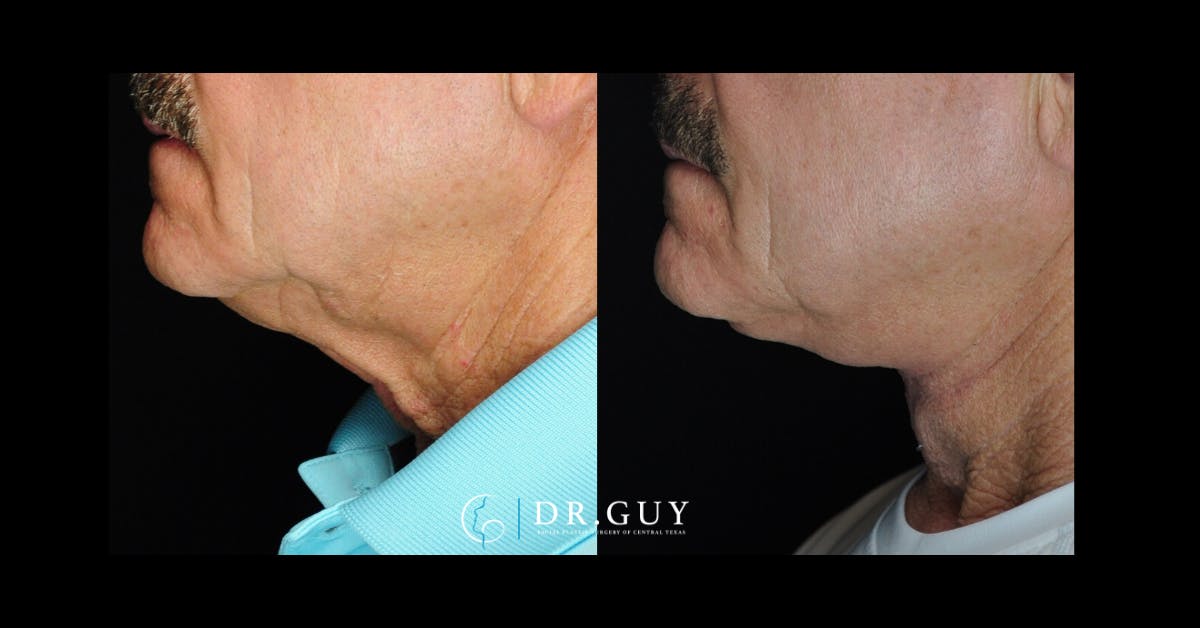 Neck Lift Before & After Gallery - Patient 338516 - Image 2