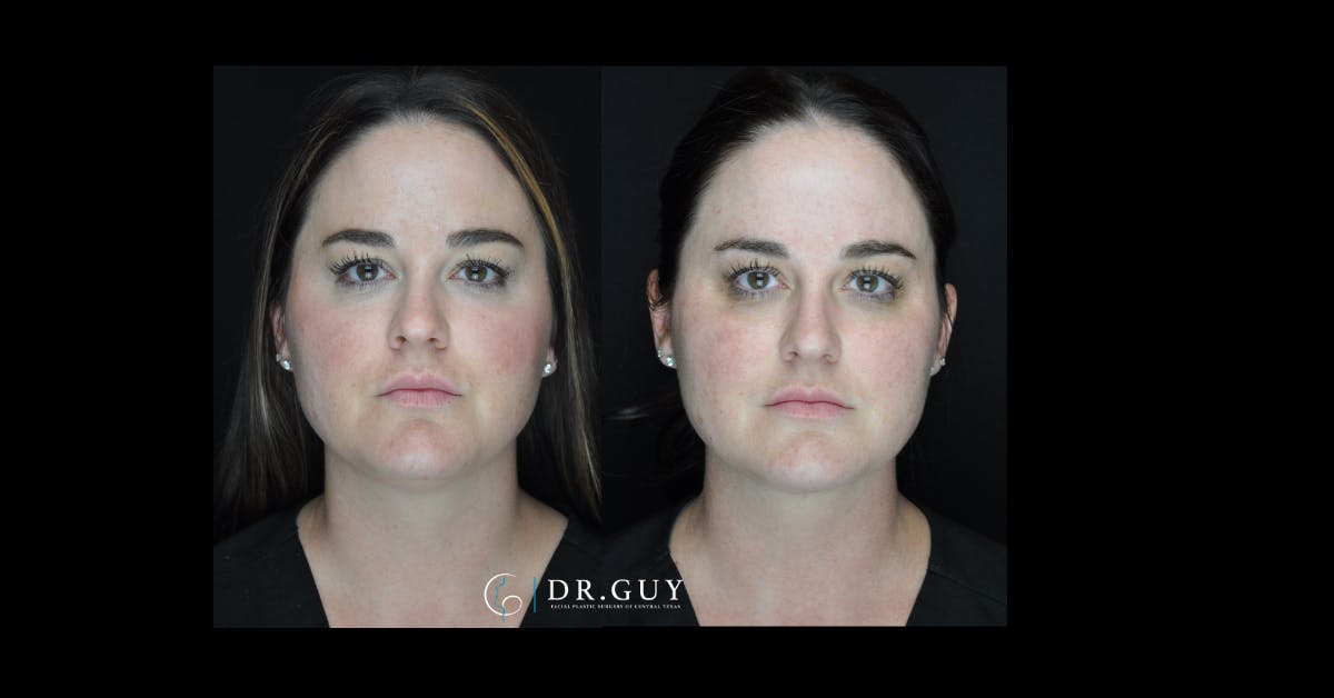 MyEllevate Before & After Gallery - Patient 156126 - Image 3