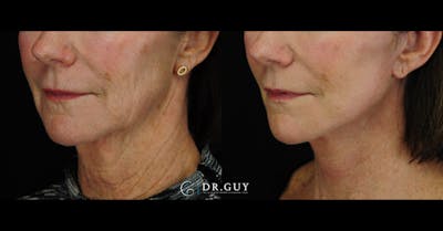 Mini Facelift Before & After Gallery - Patient 144974 - Image 1