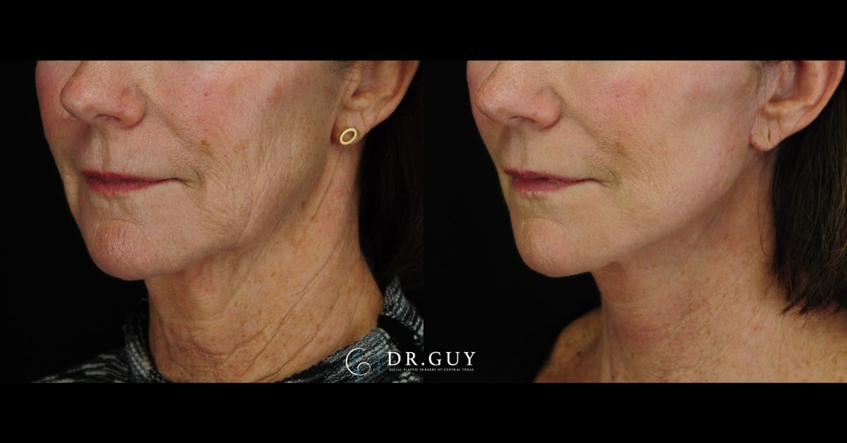 Mini Facelift Before & After Gallery - Patient 144974 - Image 1