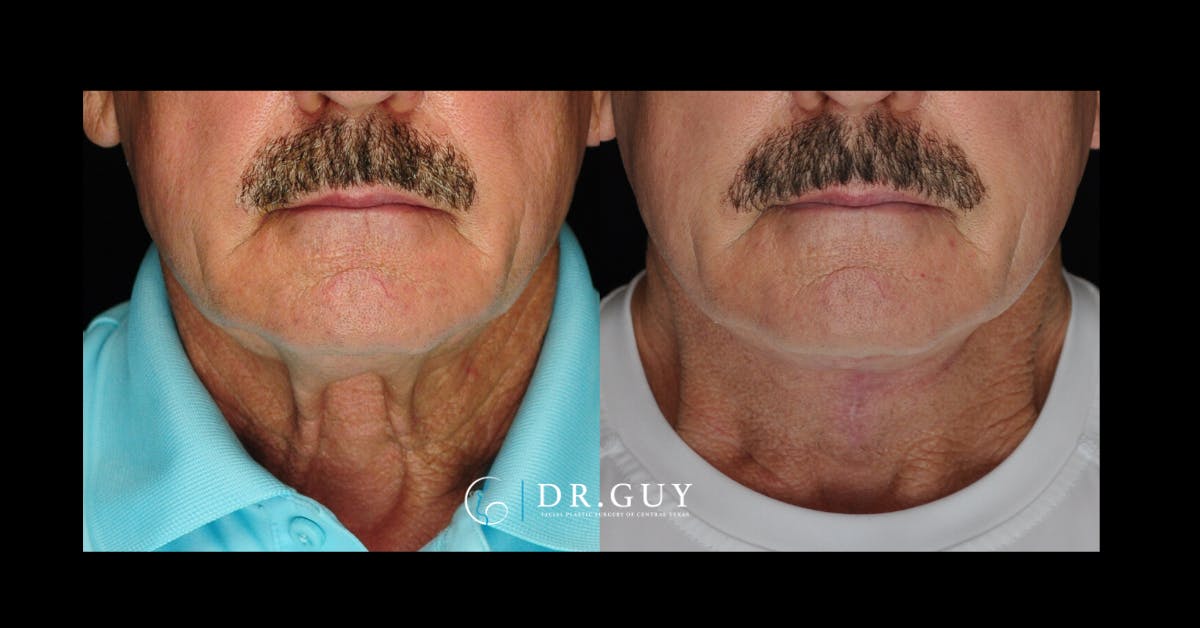 Neck Lift Before & After Gallery - Patient 338516 - Image 3