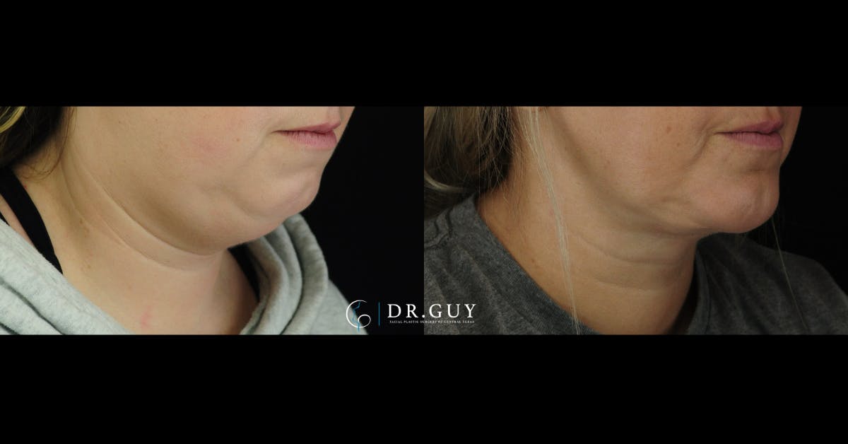 Neck Liposuction Before & After Gallery - Patient 101143 - Image 3