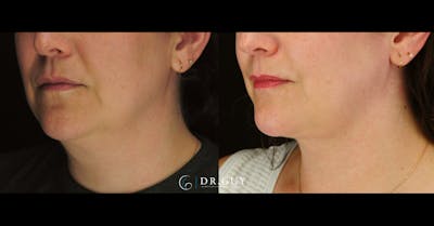 MyEllevate Before & After Gallery - Patient 287887 - Image 1