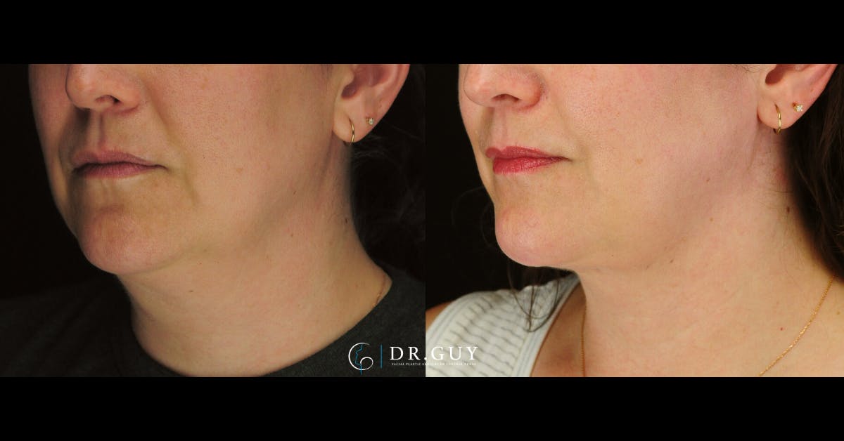 MyEllevate Before & After Gallery - Patient 287887 - Image 1