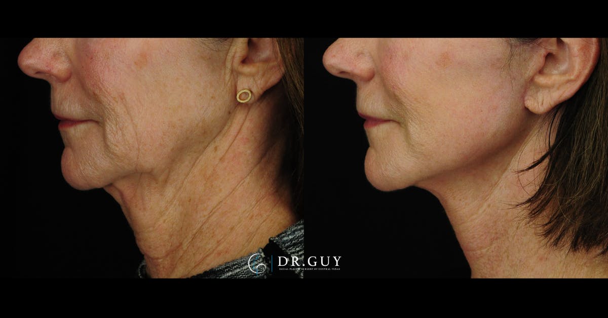 Mini Facelift Before & After Gallery - Patient 144974 - Image 2