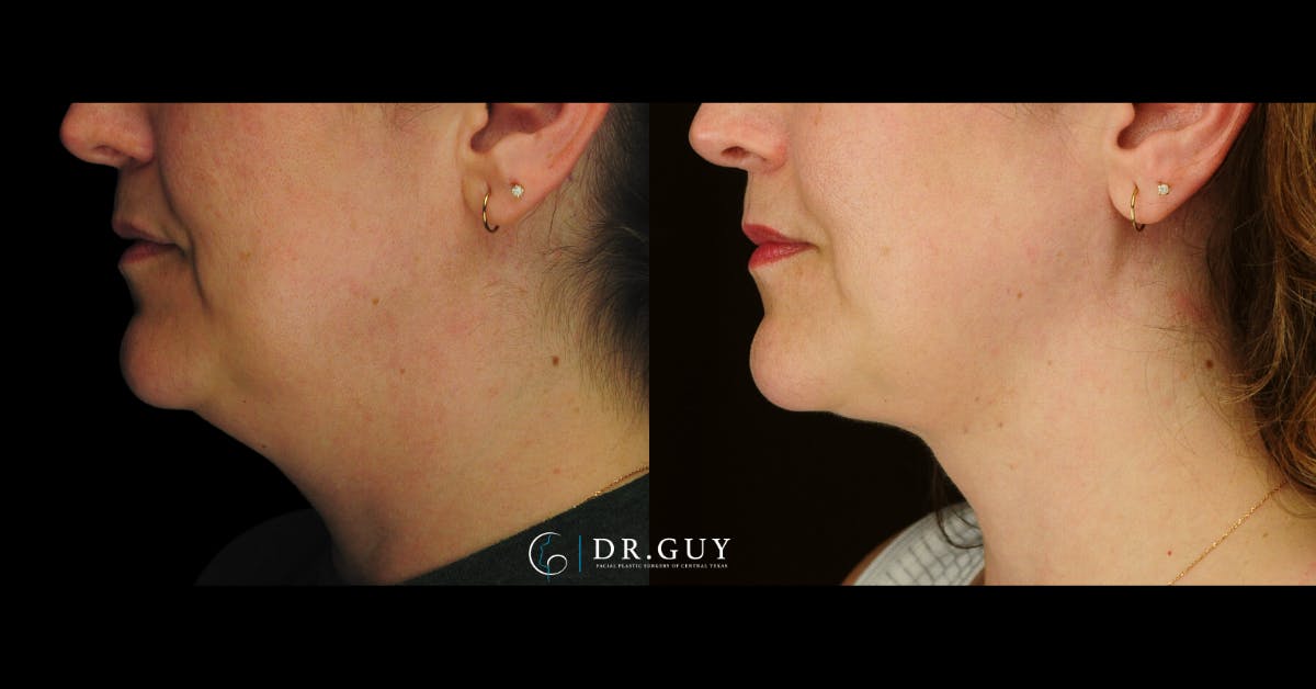 MyEllevate Before & After Gallery - Patient 287887 - Image 2