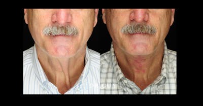 Neck Lift Before & After Gallery - Patient 209595 - Image 1