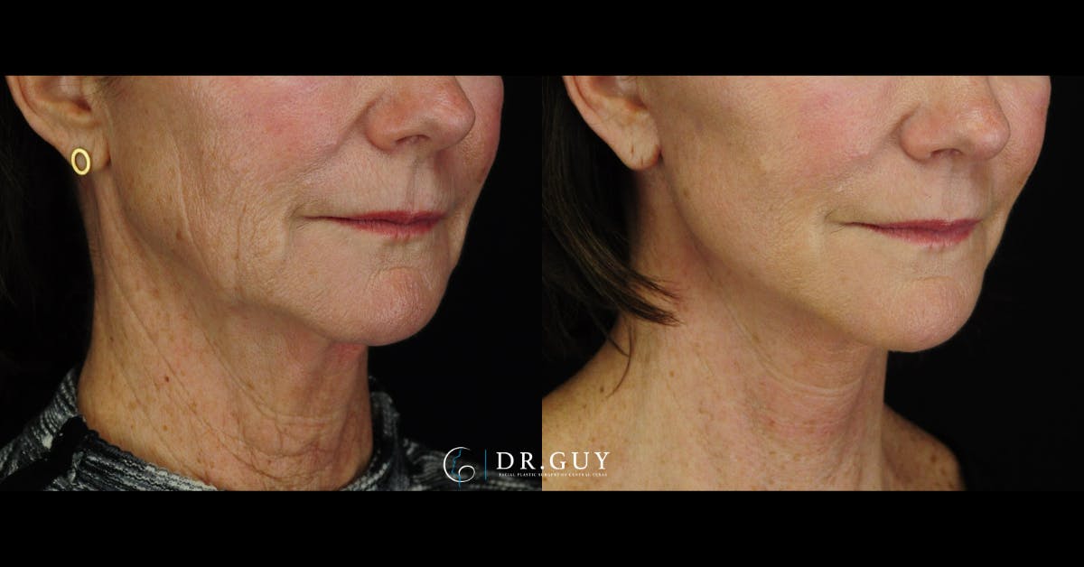 Mini Facelift Before & After Gallery - Patient 144974 - Image 3
