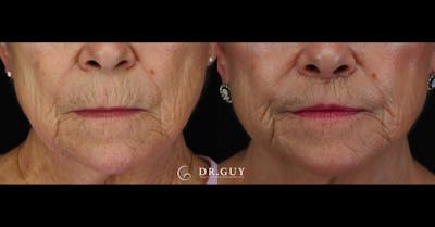 Lip Lift Before & After Gallery - Patient 299388 - Image 1