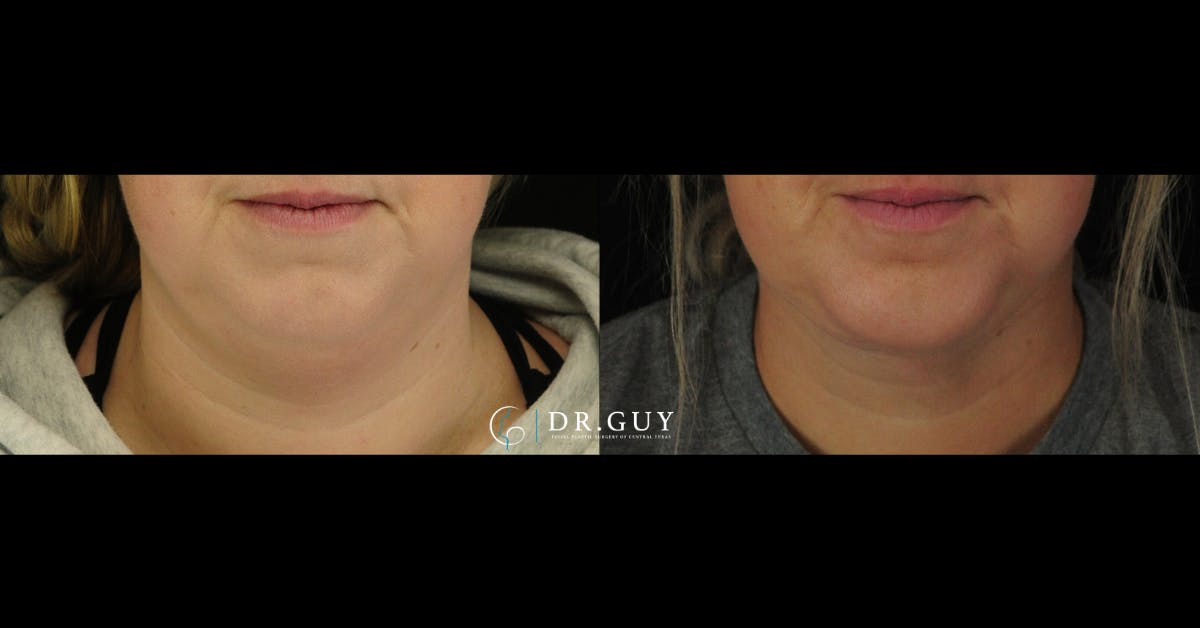 Neck Liposuction Before & After Gallery - Patient 101143 - Image 5