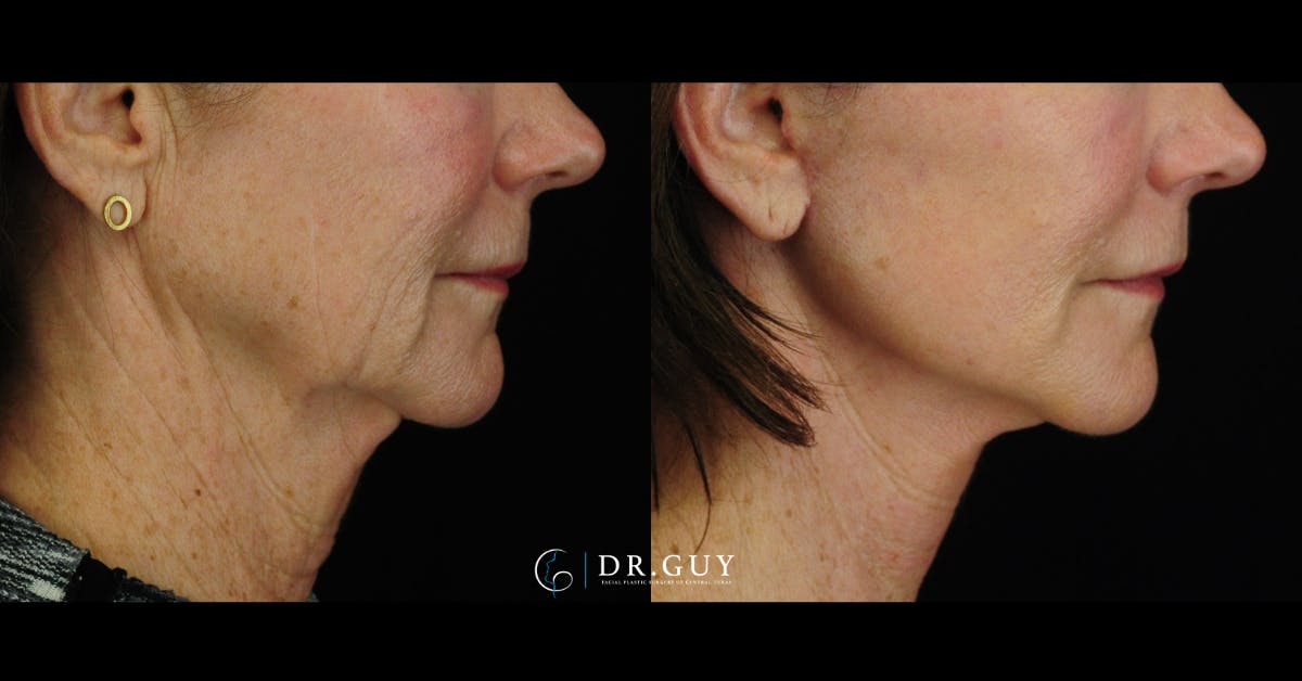 Mini Facelift Before & After Gallery - Patient 144974 - Image 4