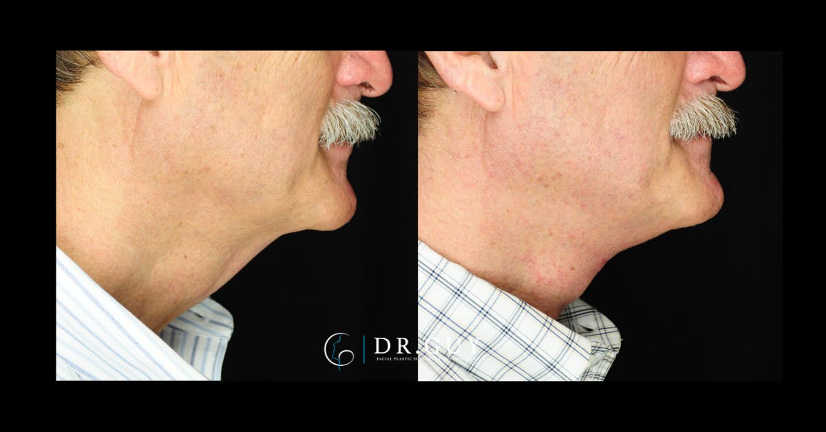 Neck Lift Before & After Gallery - Patient 209595 - Image 2