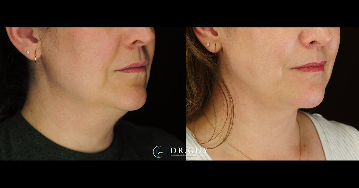 MyEllevate Before & After Gallery - Patient 287887 - Image 3