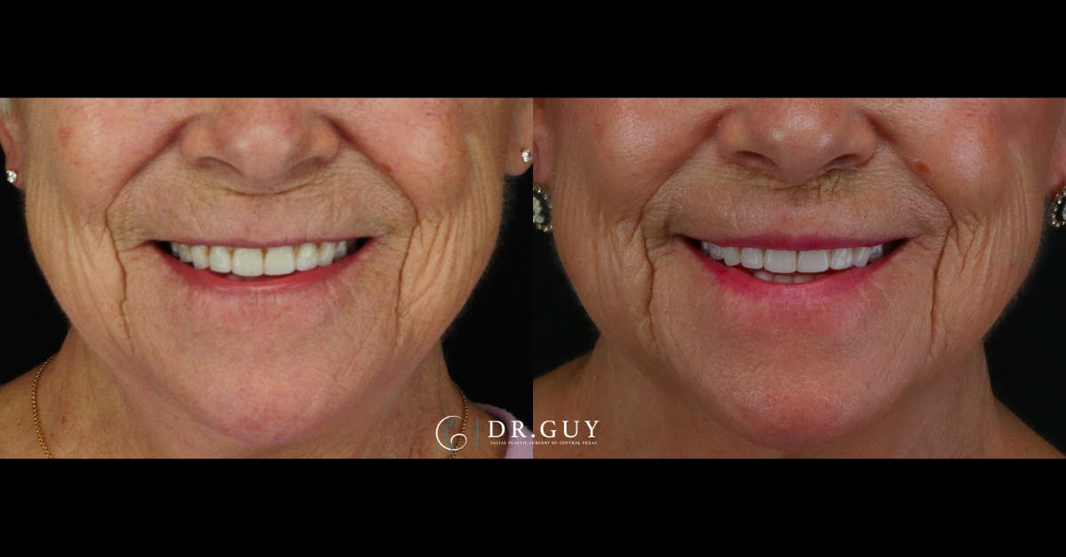 Lip Lift Before & After Gallery - Patient 299388 - Image 2
