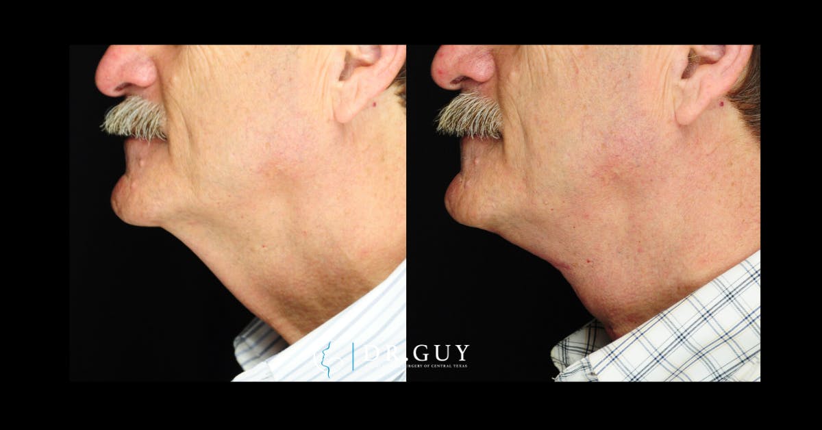 Neck Lift Before & After Gallery - Patient 209595 - Image 3