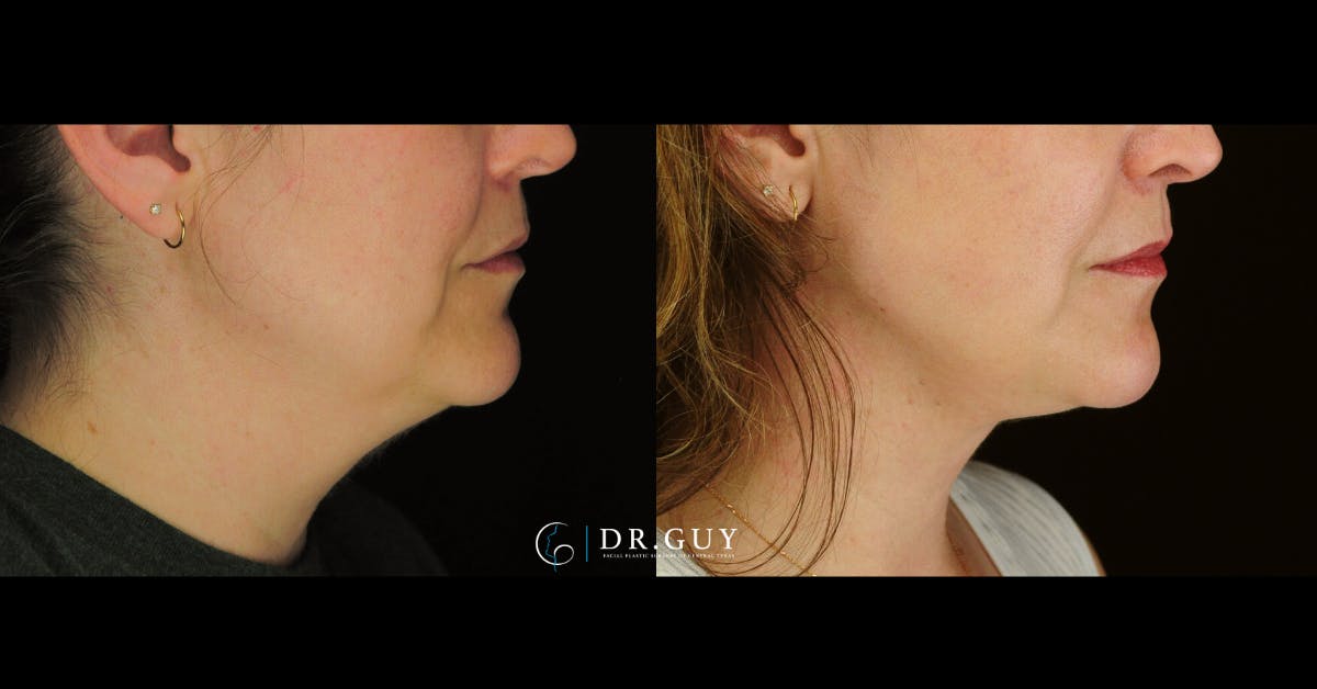 MyEllevate Before & After Gallery - Patient 287887 - Image 4