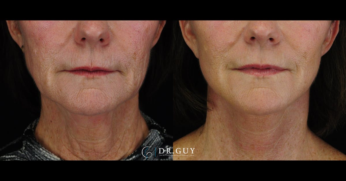 Mini Facelift Before & After Gallery - Patient 144974 - Image 5