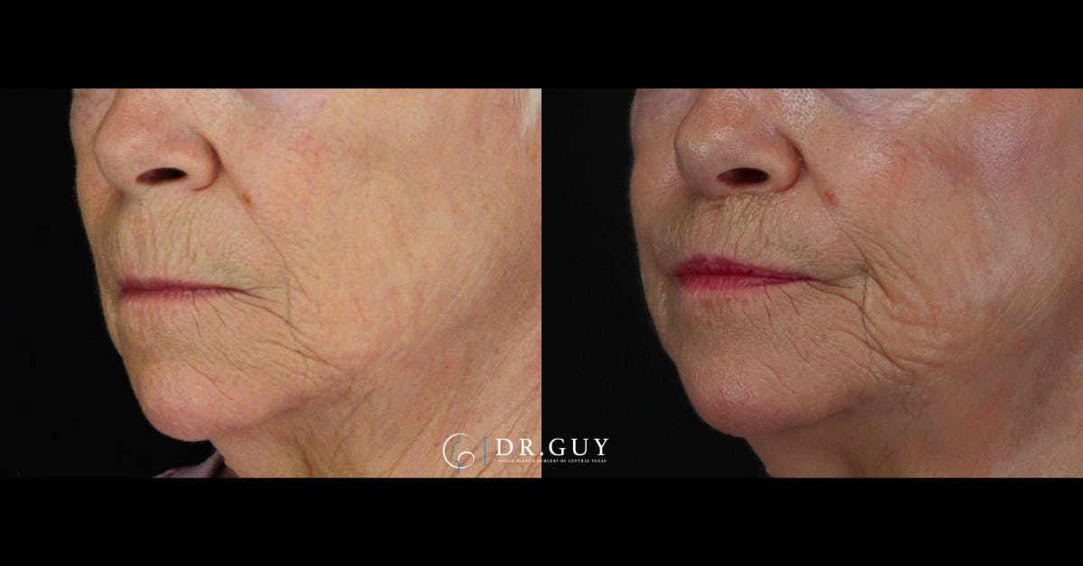 Lip Lift Before & After Gallery - Patient 299388 - Image 3