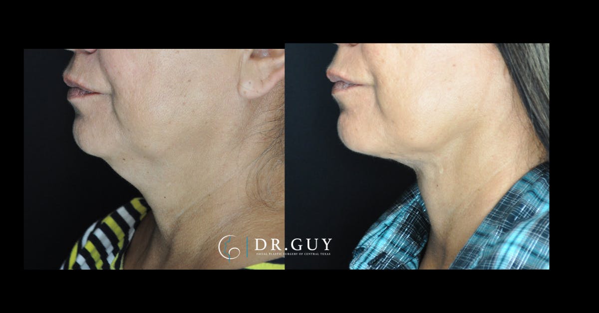 Neck Liposuction Before & After Gallery - Patient 185113 - Image 2