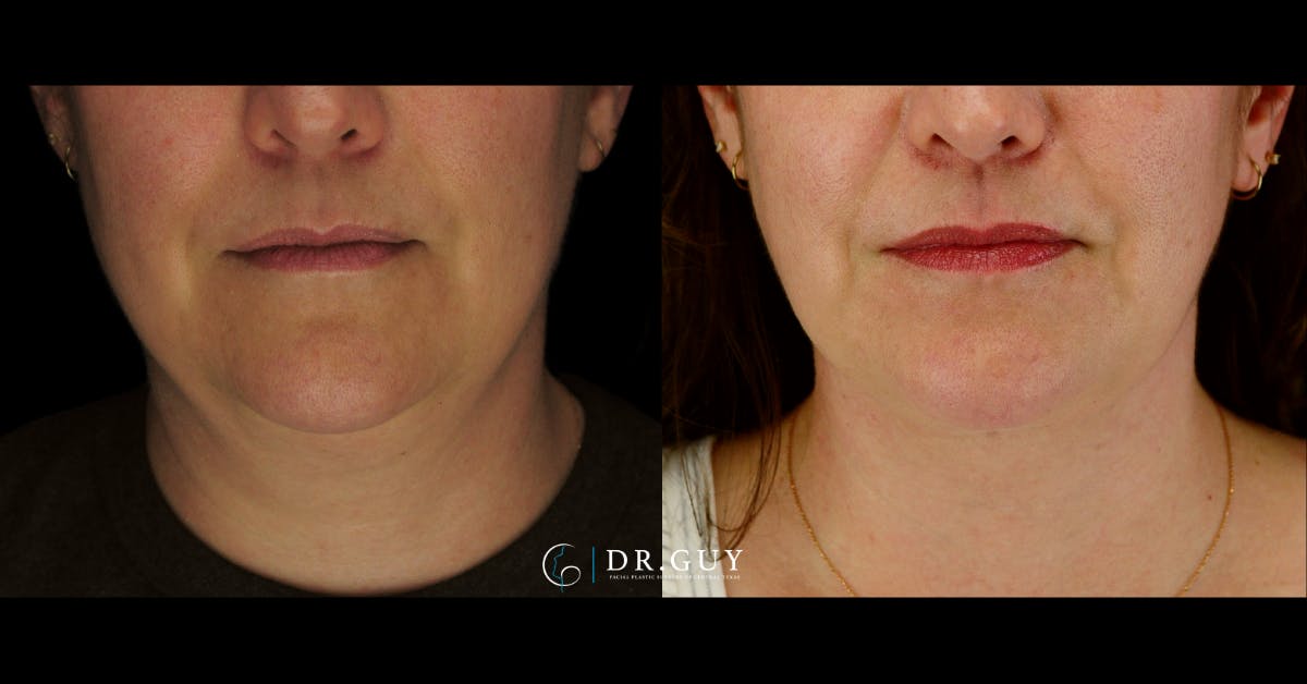 MyEllevate Before & After Gallery - Patient 287887 - Image 5