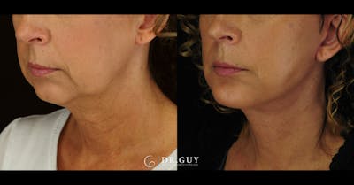 Chin Before & After Gallery - Patient 666945 - Image 1
