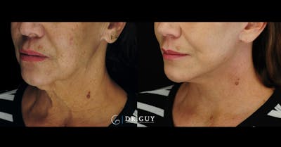 Mini Facelift Before & After Gallery - Patient 410394 - Image 1