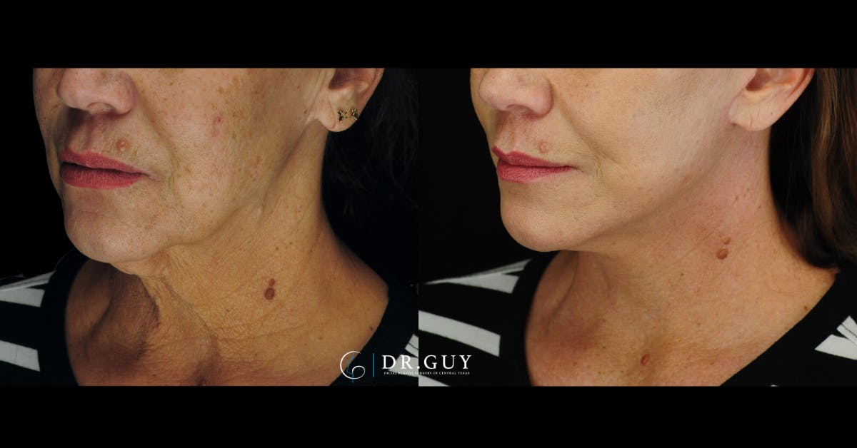 Mini Facelift Before & After Gallery - Patient 410394 - Image 1