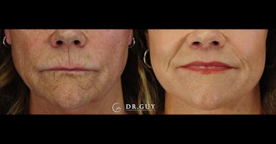 Lip Lift Before & After Gallery - Patient 279769 - Image 1