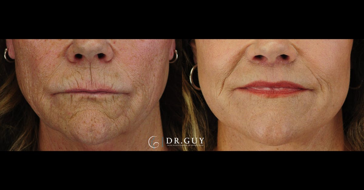 Lip Lift Before & After Gallery - Patient 279769 - Image 1
