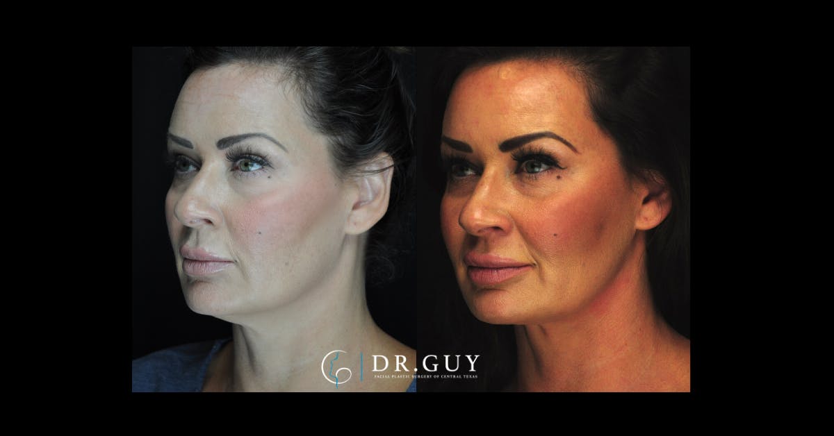 MyEllevate Before & After Gallery - Patient 167735 - Image 1