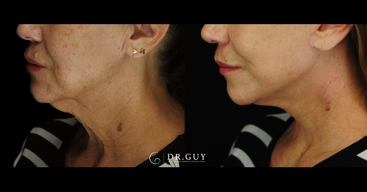 Mini Facelift Before & After Gallery - Patient 410394 - Image 2