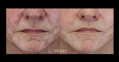 Lip Lift Before & After Gallery - Patient 210337 - Image 1