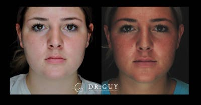Neck Liposuction Before & After Gallery - Patient 862909 - Image 1