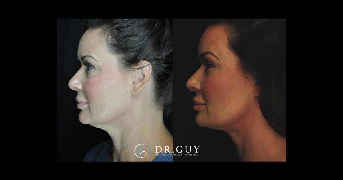 MyEllevate Before & After Gallery - Patient 167735 - Image 2