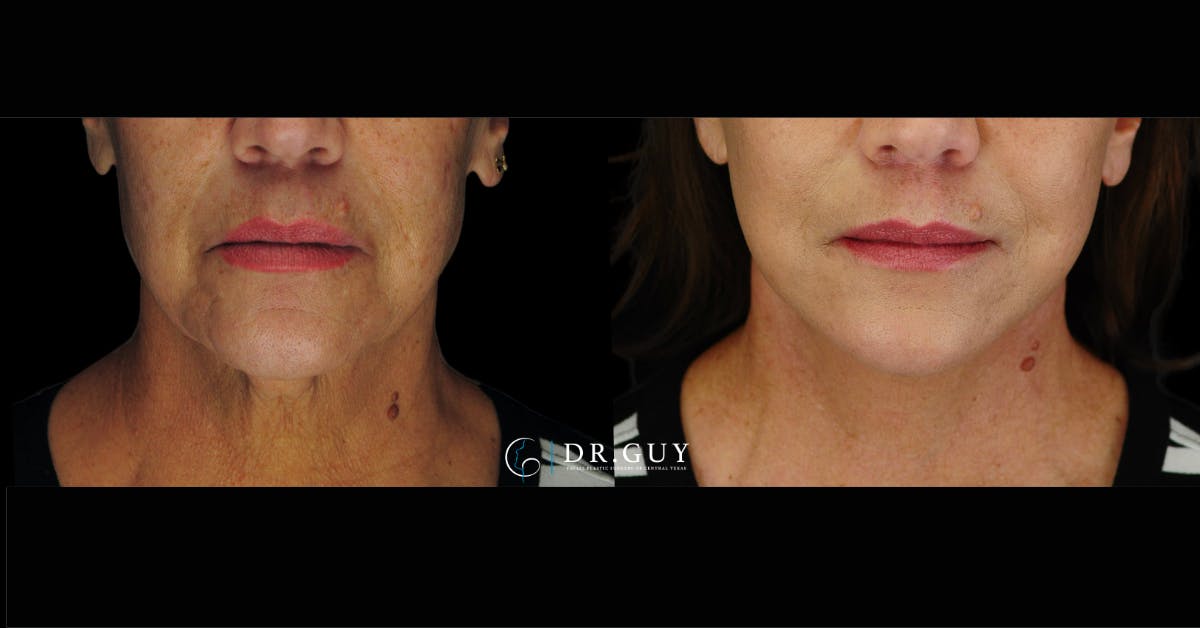 Mini Facelift Before & After Gallery - Patient 410394 - Image 3