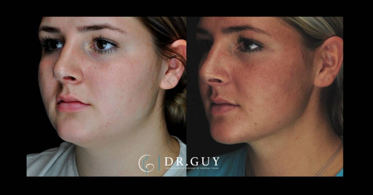 Neck Liposuction Before & After Gallery - Patient 862909 - Image 2