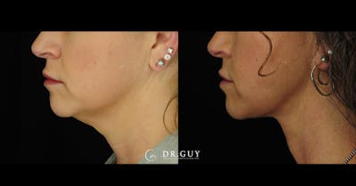 FaceTite Before & After Gallery - Patient 198911 - Image 1