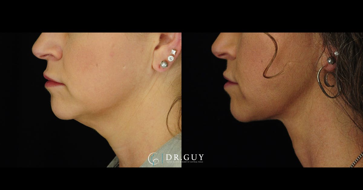 FaceTite Before & After Gallery - Patient 198911 - Image 1