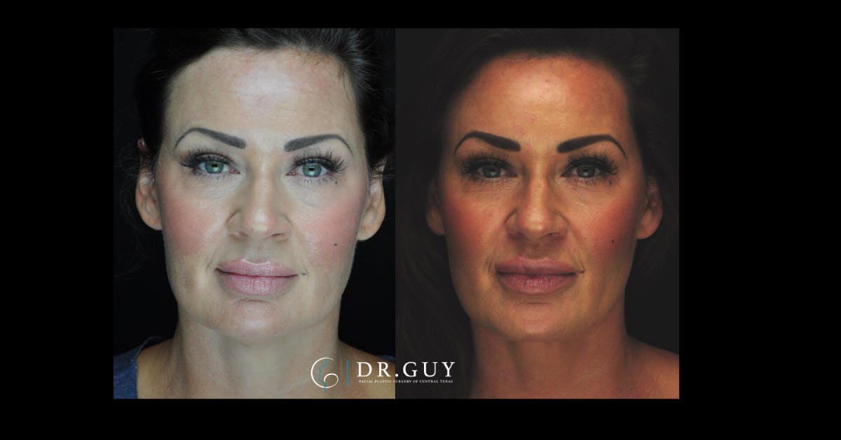 MyEllevate Before & After Gallery - Patient 167735 - Image 3