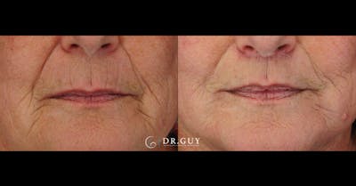 Lip Lift Before & After Gallery - Patient 286293 - Image 1