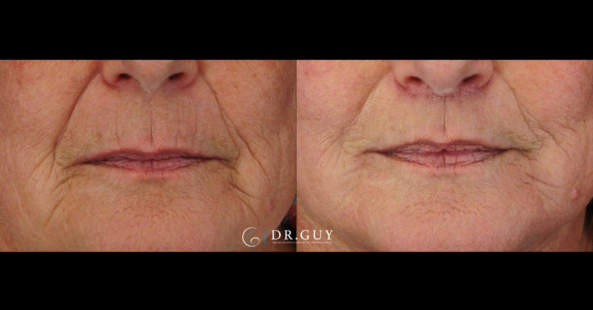 Lip Lift Before & After Gallery - Patient 286293 - Image 1