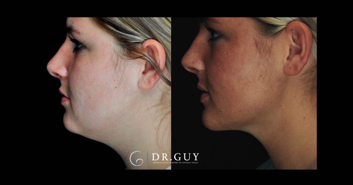 Neck Liposuction Before & After Gallery - Patient 862909 - Image 3