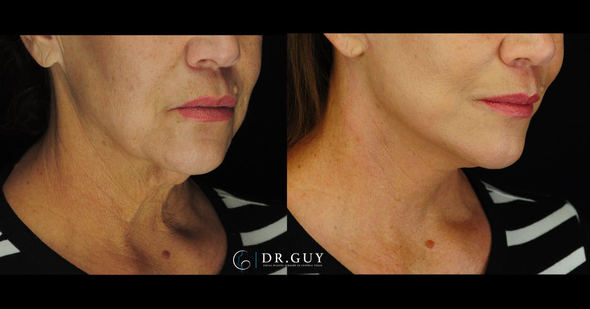Mini Facelift Before & After Gallery - Patient 410394 - Image 4