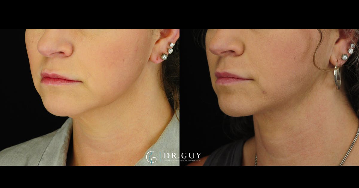 FaceTite Before & After Gallery - Patient 198911 - Image 2