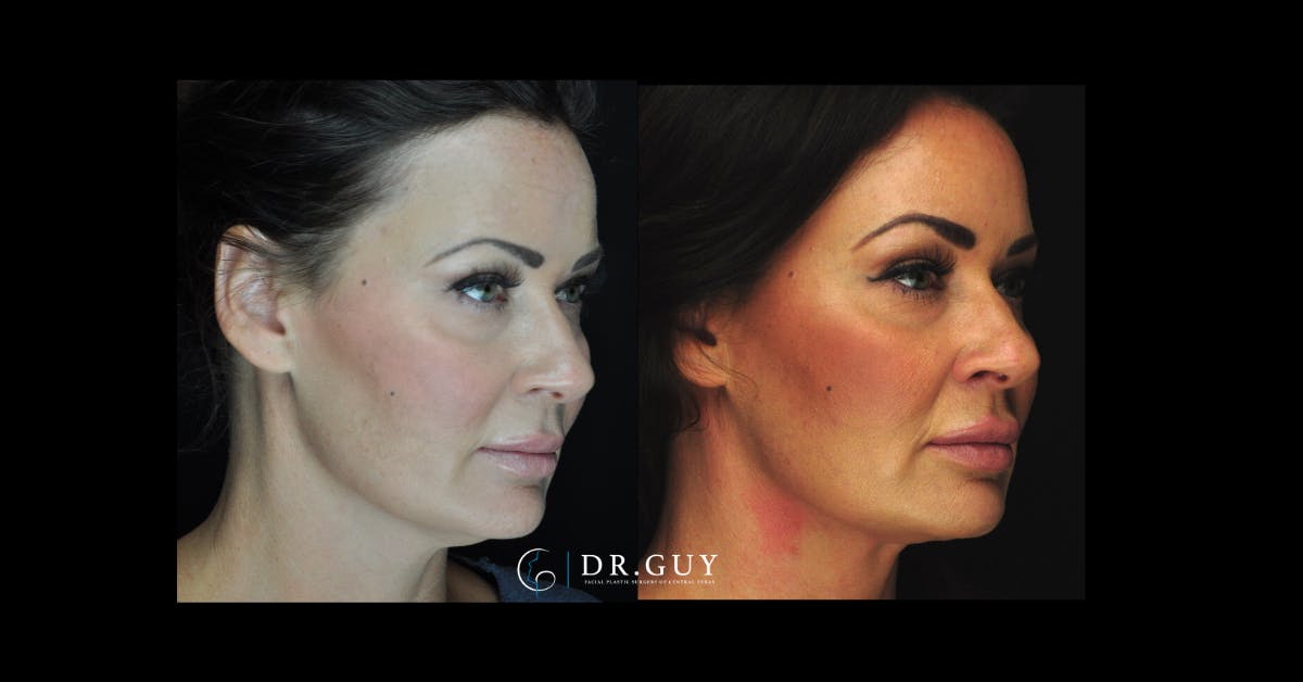 MyEllevate Before & After Gallery - Patient 167735 - Image 4